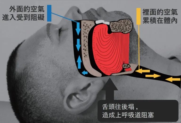 通過這樣訓練就能改善睡覺打呼嚕（轉給需要的...）